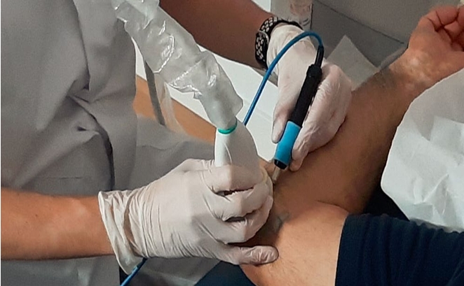 Electrólisis percutánea